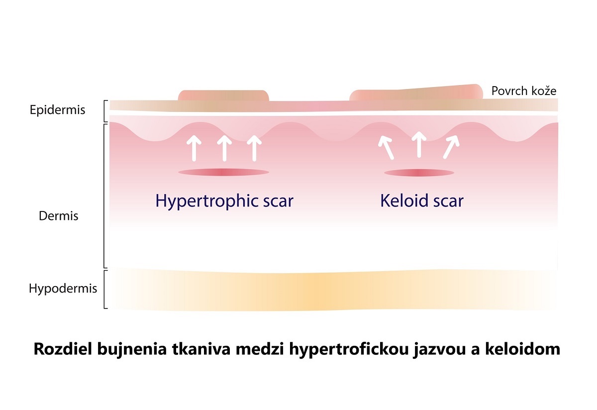 rozdiel rastu tkaniva medzi hypertorfickou jazvou a keloidom